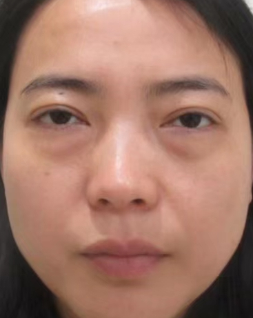 去眼袋手术