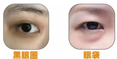 去眼袋手术