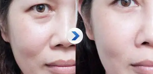 去眼袋手术