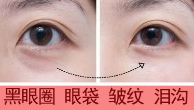去眼袋手术