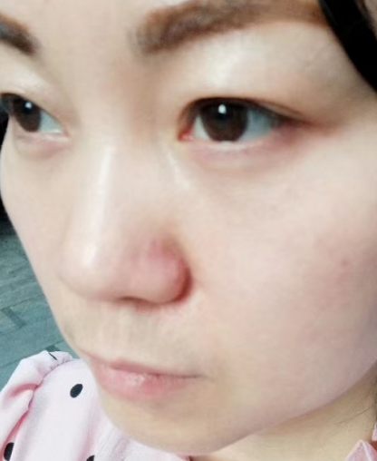 去眼袋手术