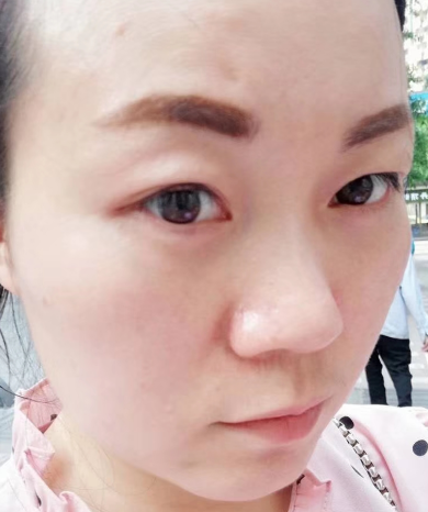 去眼袋手术