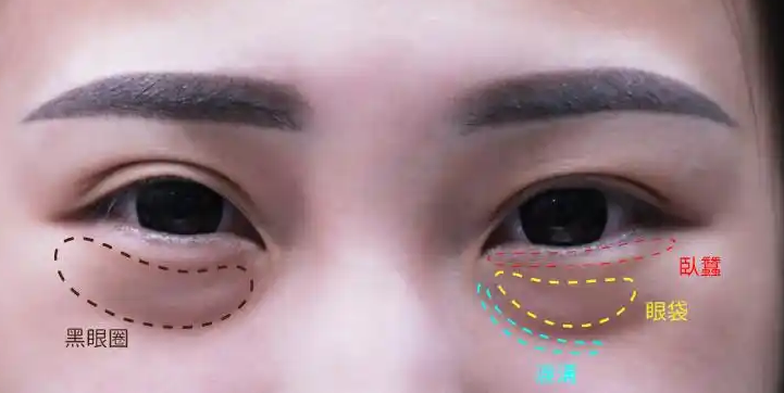去眼袋手术