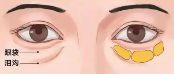 去眼袋手术