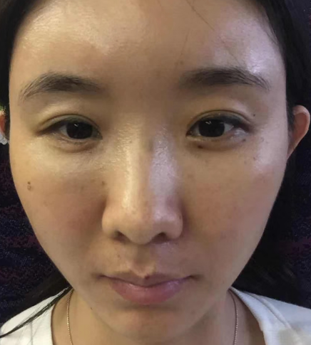去眼袋手术