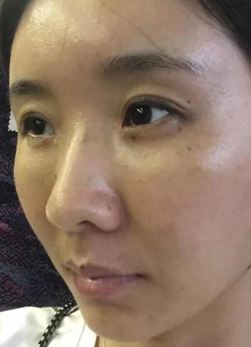 去眼袋手术