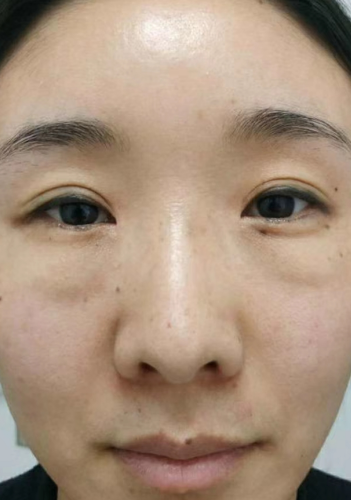去眼袋手术