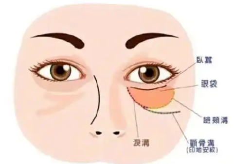 去眼袋手术