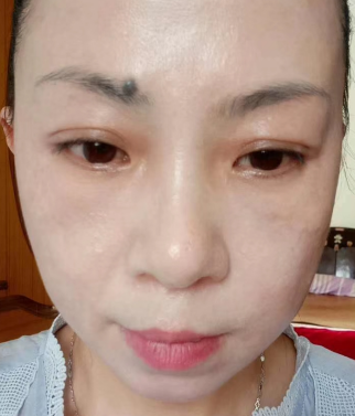 去眼袋手术