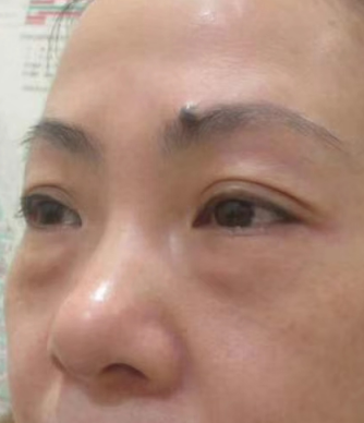 去眼袋手术
