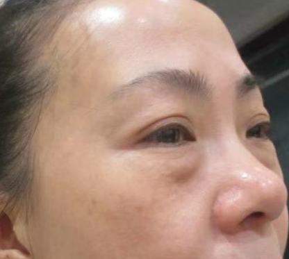 去眼袋手术