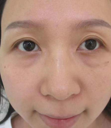 去眼袋手术
