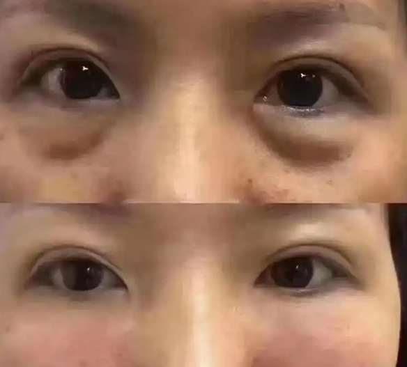 眼袋