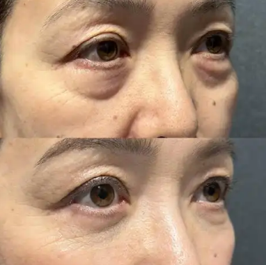 眼袋