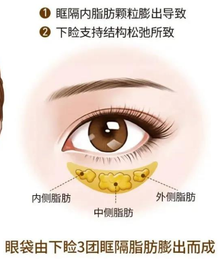 眼袋