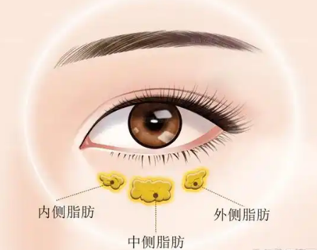眼袋