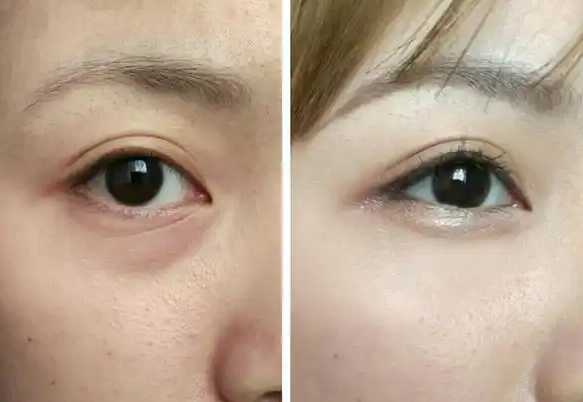 眼袋