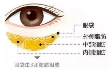去眼袋手术