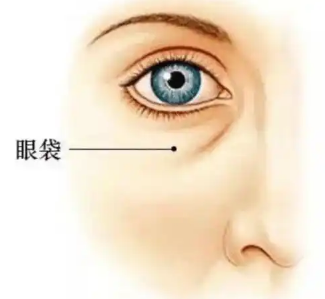 去眼袋手术