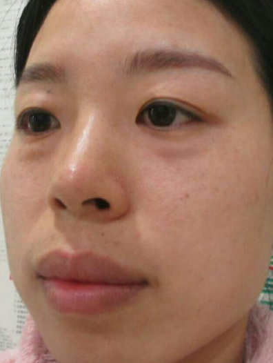 去眼袋手术