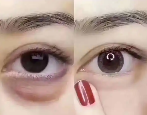 眼袋