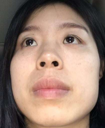 去眼袋手术
