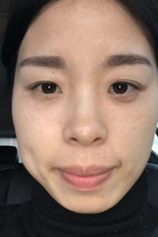 去眼袋手术