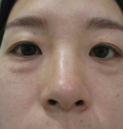 去眼袋手术