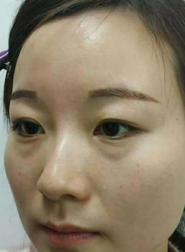 去眼袋手术