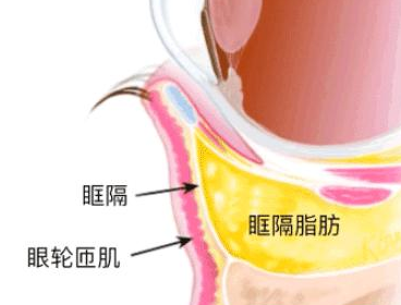 去眼袋手术