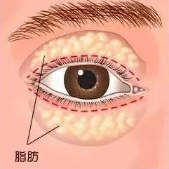 去眼袋手术