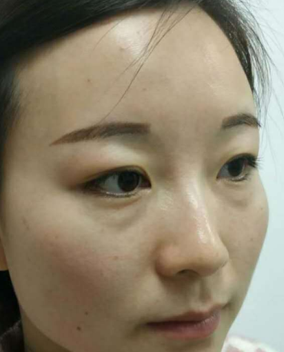 去眼袋手术