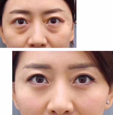 眼袋