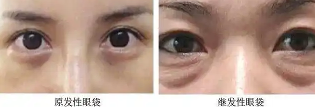 眼袋
