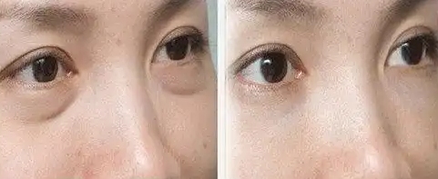 眼袋