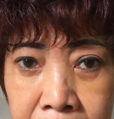 去眼袋手术