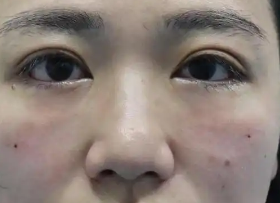 去眼袋手术