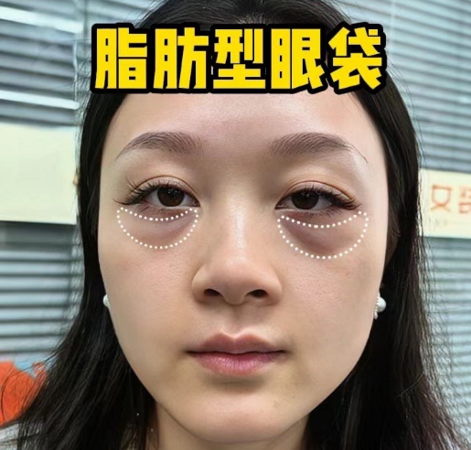 去眼袋手术