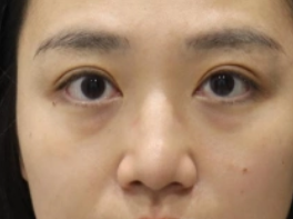 去眼袋手术