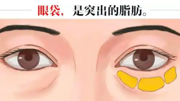 去眼袋手术
