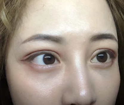 去眼袋手术
