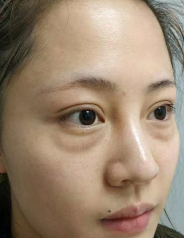 去眼袋手术