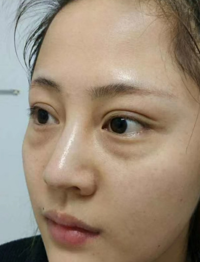 去眼袋手术