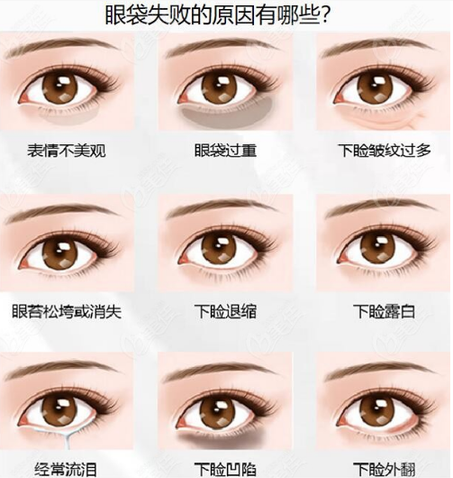 去眼袋手术
