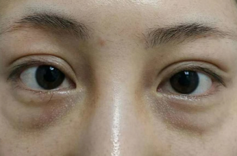 去眼袋手术