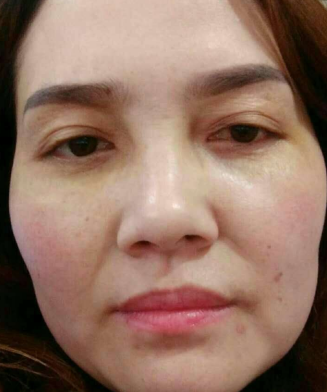 去眼袋手术