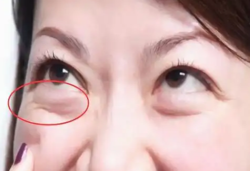去眼袋手术
