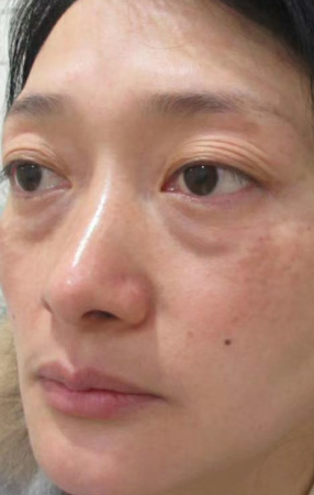 去眼袋手术