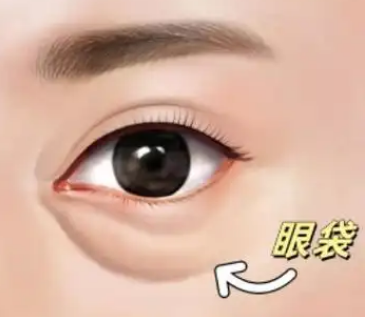 眼袋