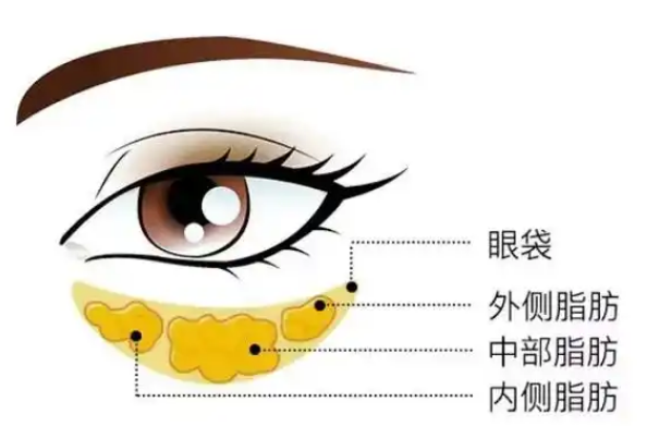 眼袋